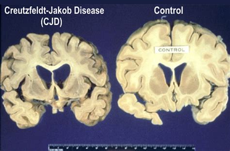 cbsjd|Creutzfeldt–Jakob disease .